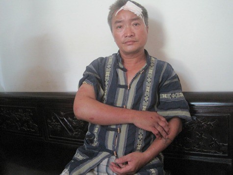 Anh Đàm Văn Đồng bị đánh trọng thương phải khâu 10 mũi ở đầu